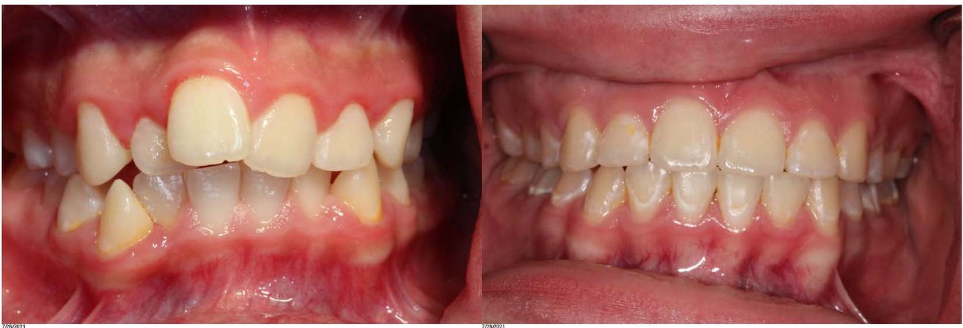 Orthodontic before and after — case 6