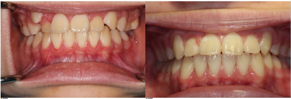 Orthodontic before and after — case 11
